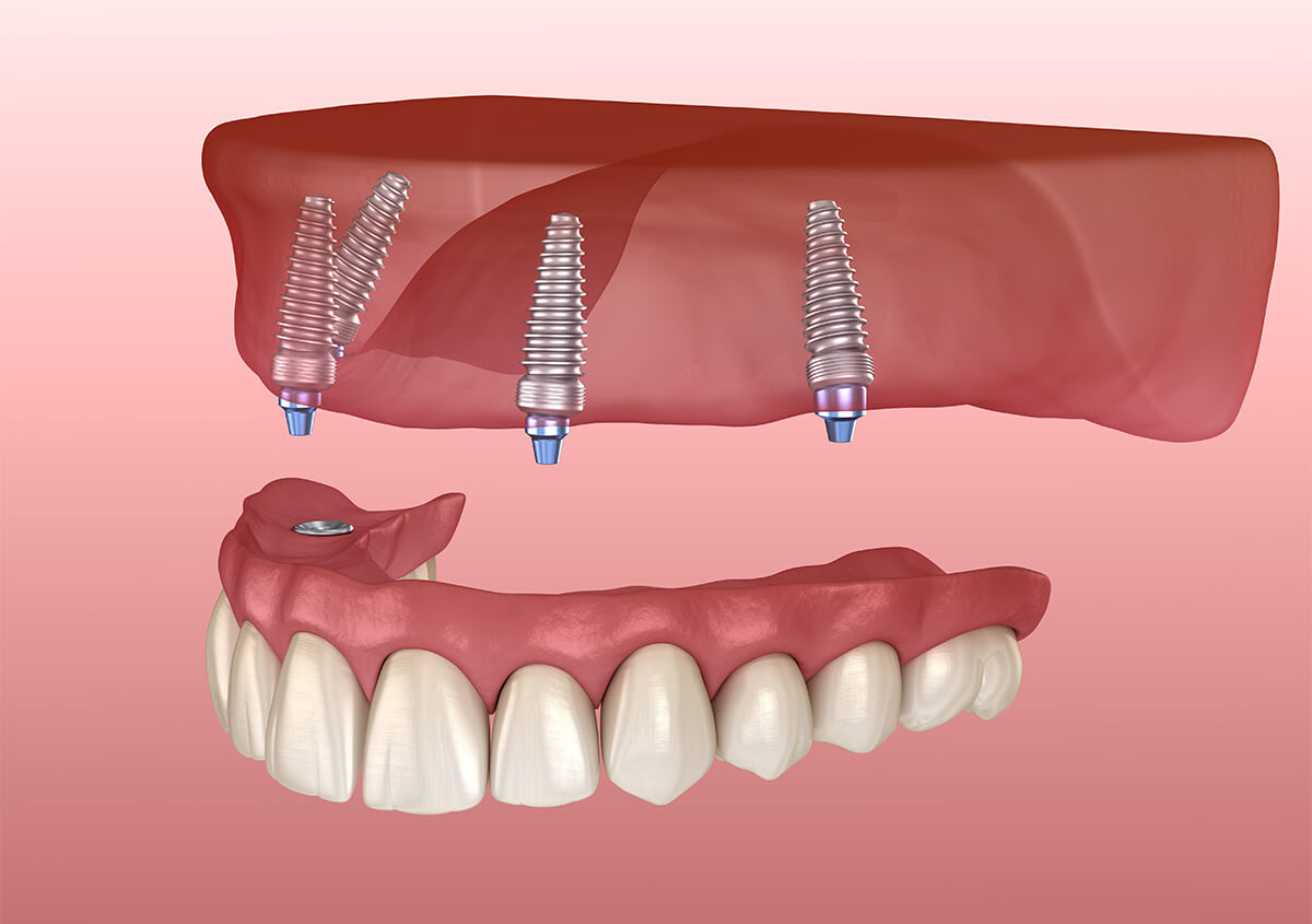 How Long Do Full Arch Dental Implants Last in Rohnert Park Area